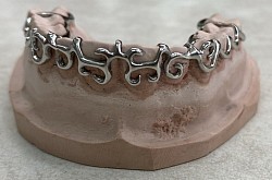 New Retainer Design (รีเทนเนอร์โลหะ)