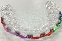 New Retainer Design (รีเทนเนอร์ที่ใส่แล้วเหมือนจัดฟัน)