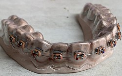 New Retainer Design (รีเทนเนอร์ที่ใส่แล้วเหมือนจัดฟัน)